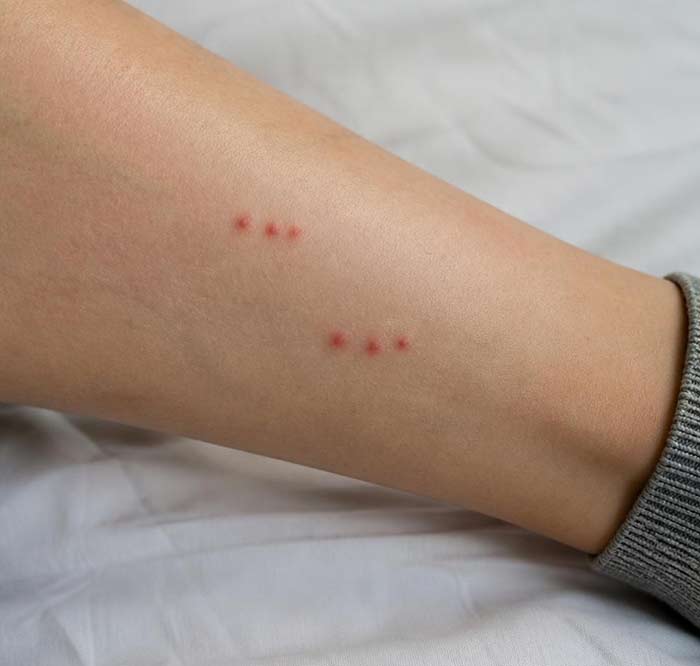 Typical bed bug bite pattern — small red bumps in a zigzag line on arms and legs